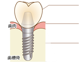 インプラント上部構造、アパットメント、インプラント