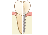 インプラント