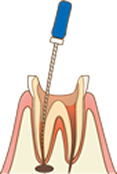 歯内療法について