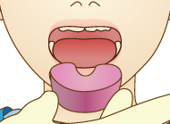 フッ素は歯を強くする成分で、虫歯に対して抵抗力の弱い乳歯などをを虫歯から守る薬剤です。