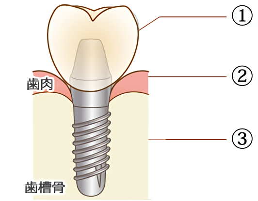 インプラント