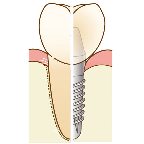 インプラント