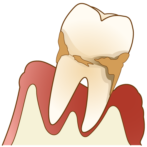 歯周病治療について