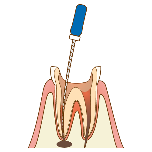 歯内療法について
